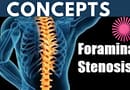 Foraminal Stenosis