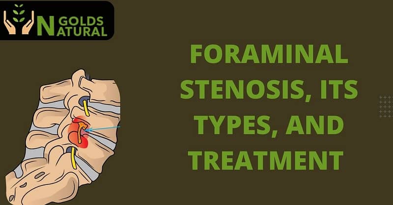 Foraminal Stenosis, its Types, and Treatment 